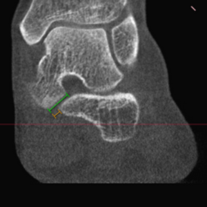 weight bearing CT