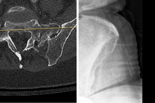 Barr Debaun procedure
