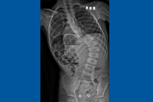 Scoliosis catanzano