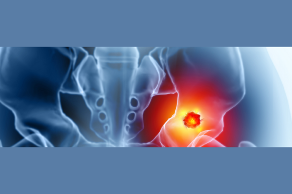 osteosarcoma