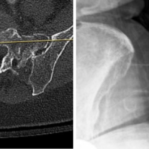 Barr Debaun procedure