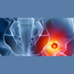 osteosarcoma